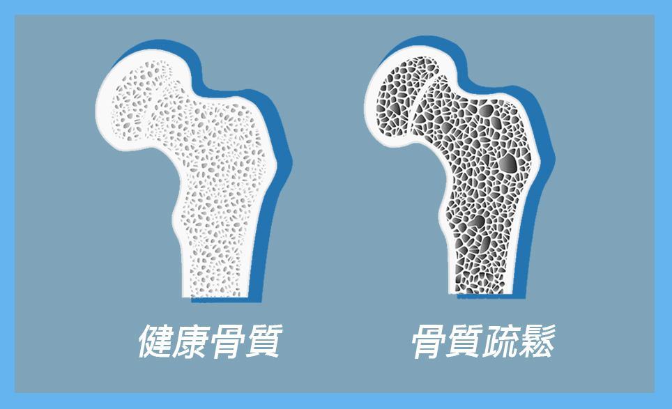 年齡越大「骨頭越鬆」！提醒：遠離3物「尤其是一白」做好3事　遠離骨質疏鬆「骨頭強健」