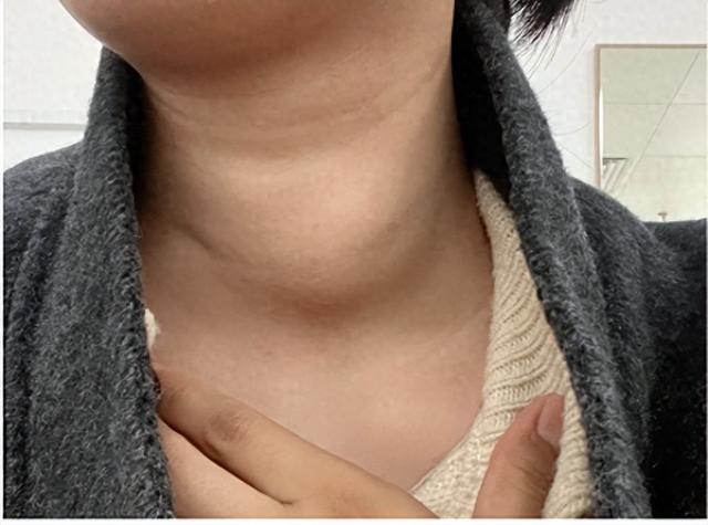 甲狀腺早期不是脖子粗大！醫生強調「出現這4異常」：趕快就醫
